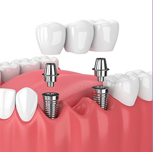 Implant Solutions